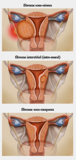 3 sortes de fibrom